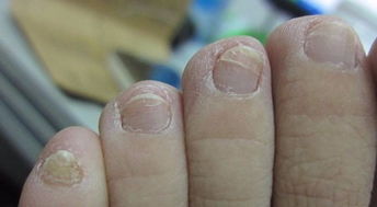 指甲花治疗灰指甲怎么使用[指甲花治疗灰指甲效果好吗?]